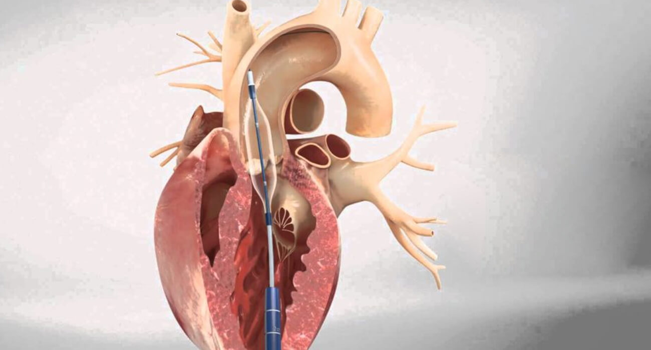 TRANS CATHETER AORTIC VALVE IMPLANTATION